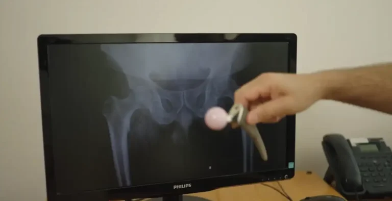 תמונה למאמר החלפת מפרק ירך בגישה קדמית