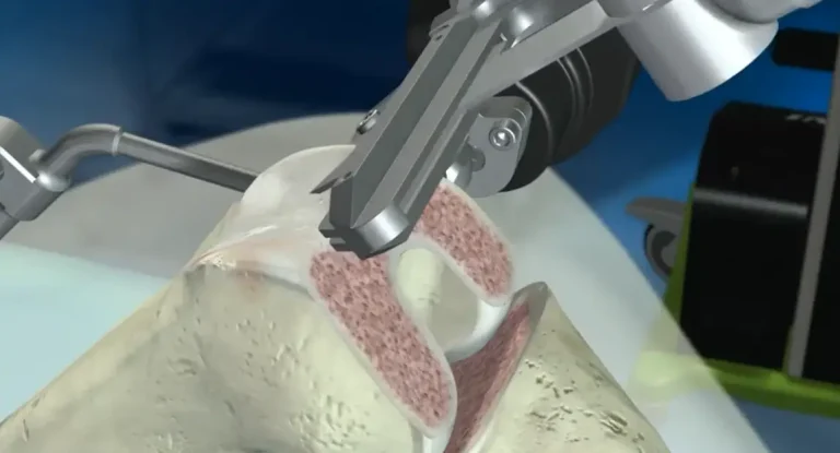 ROBOTIC ASSISTED TOTAL KNEE ARTHROPLASTY/ REPLACEMENT