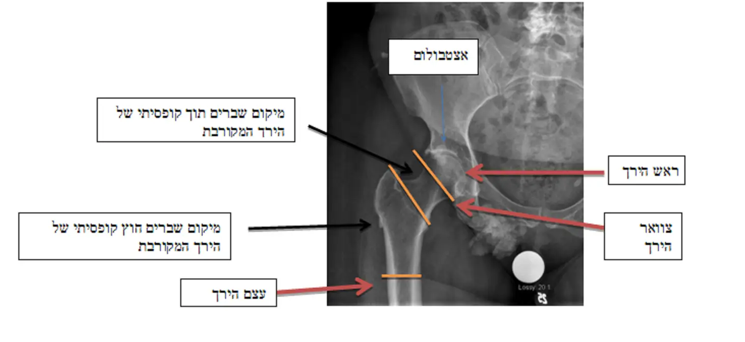 שברי צוואר ירך - תמונה מדגימה